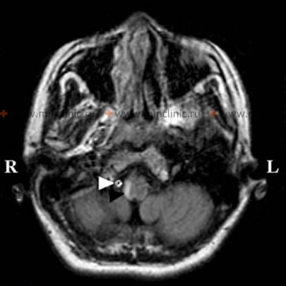 МРТ показывает расслоение правой позвоночной артерии (белая стрелка), что сопровождается инсультом в стволе мозга (в продолговатый мозг, чёрная стрелка).